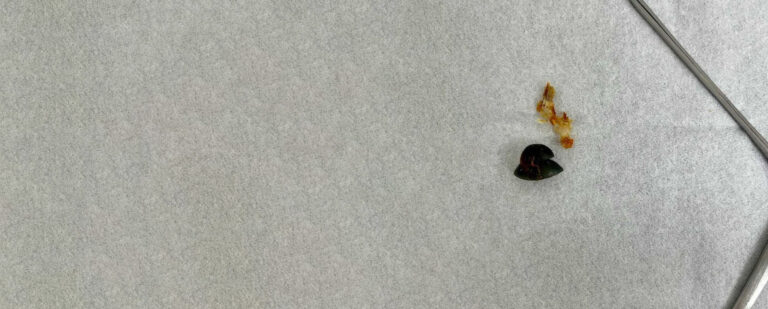 hearing-aid-dome-removal-tympahealth-banner2