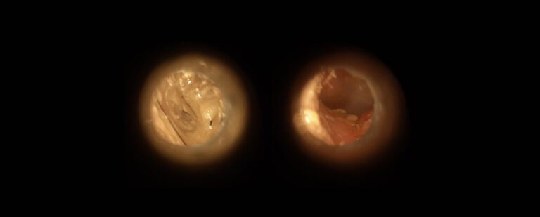 hear-hear-wax-clear-case-study-social-isolation-before-and-after-banner